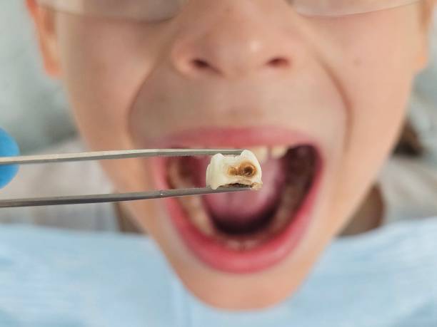 Best Emergency Tooth Extraction in Vienna Bend, LA